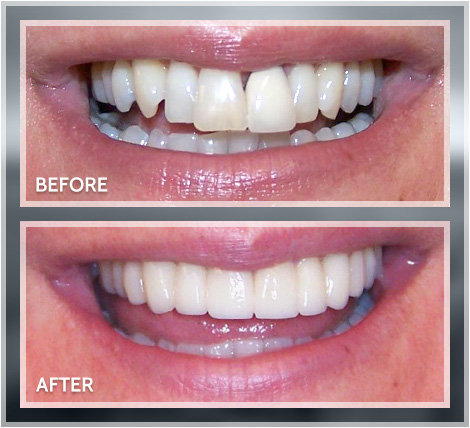 Front teeth repair 🔥###trinidaddentist #trini_tiktoks #cosmeticbondin