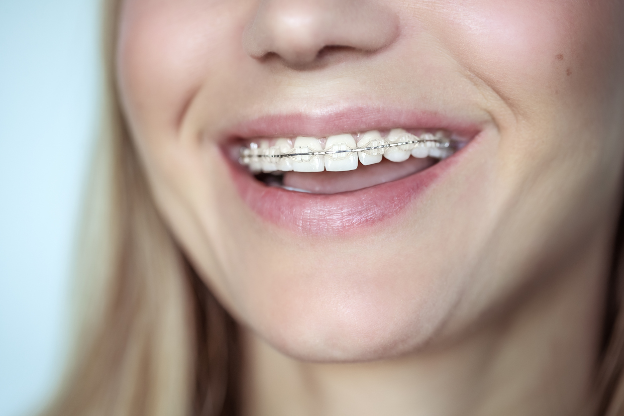 Braces, treatment for a crooked teeth, closeup photo of a beautiful smile of a young woman with white clean teeth, aesthetic dentistry and dental care concept